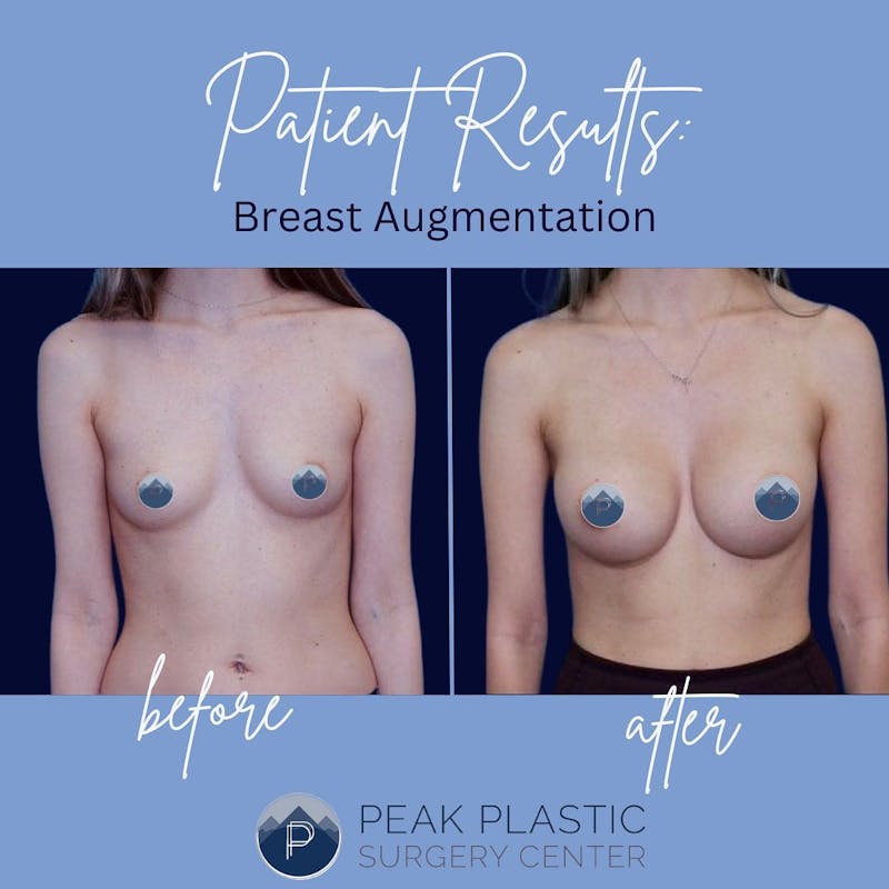 Breast Augmentation Before & After Gallery - Patient 60748741 - Image 1