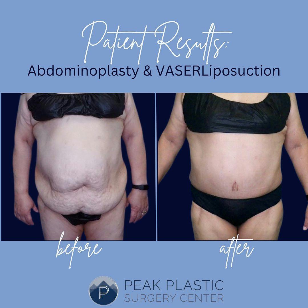 Vaser Liposuction Before & After Gallery - Patient 60748751 - Image 1