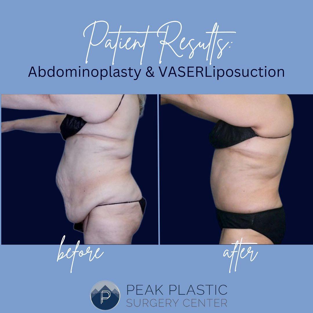 Vaser Liposuction Before & After Gallery - Patient 60748751 - Image 2