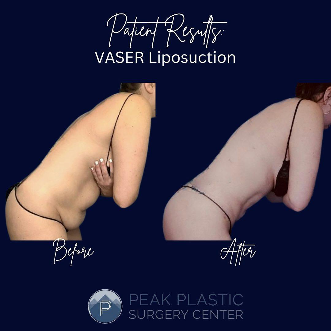Vaser Liposuction Before & After Gallery - Patient 55611655 - Image 2