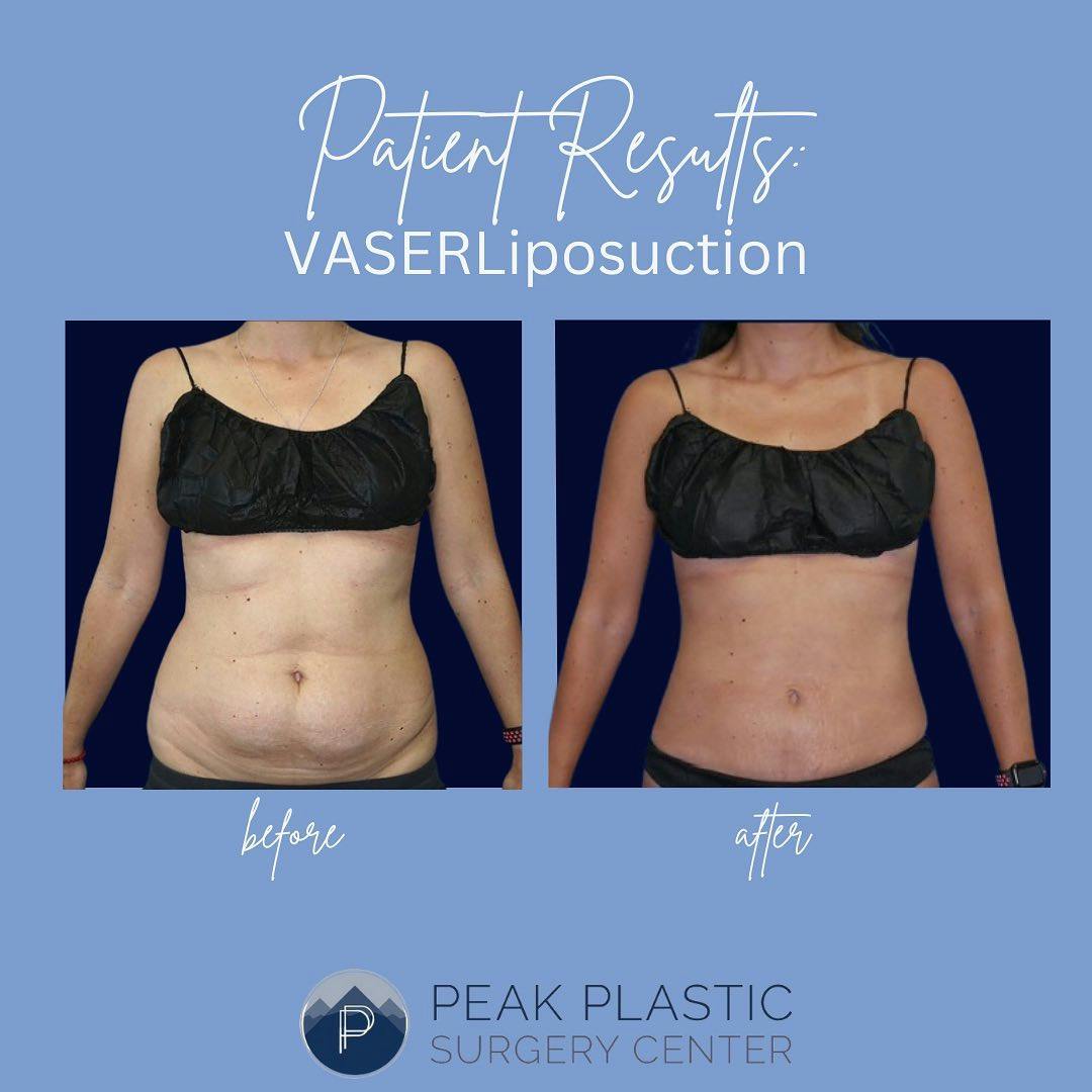 Vaser Liposuction Before & After Gallery - Patient 60748768 - Image 1