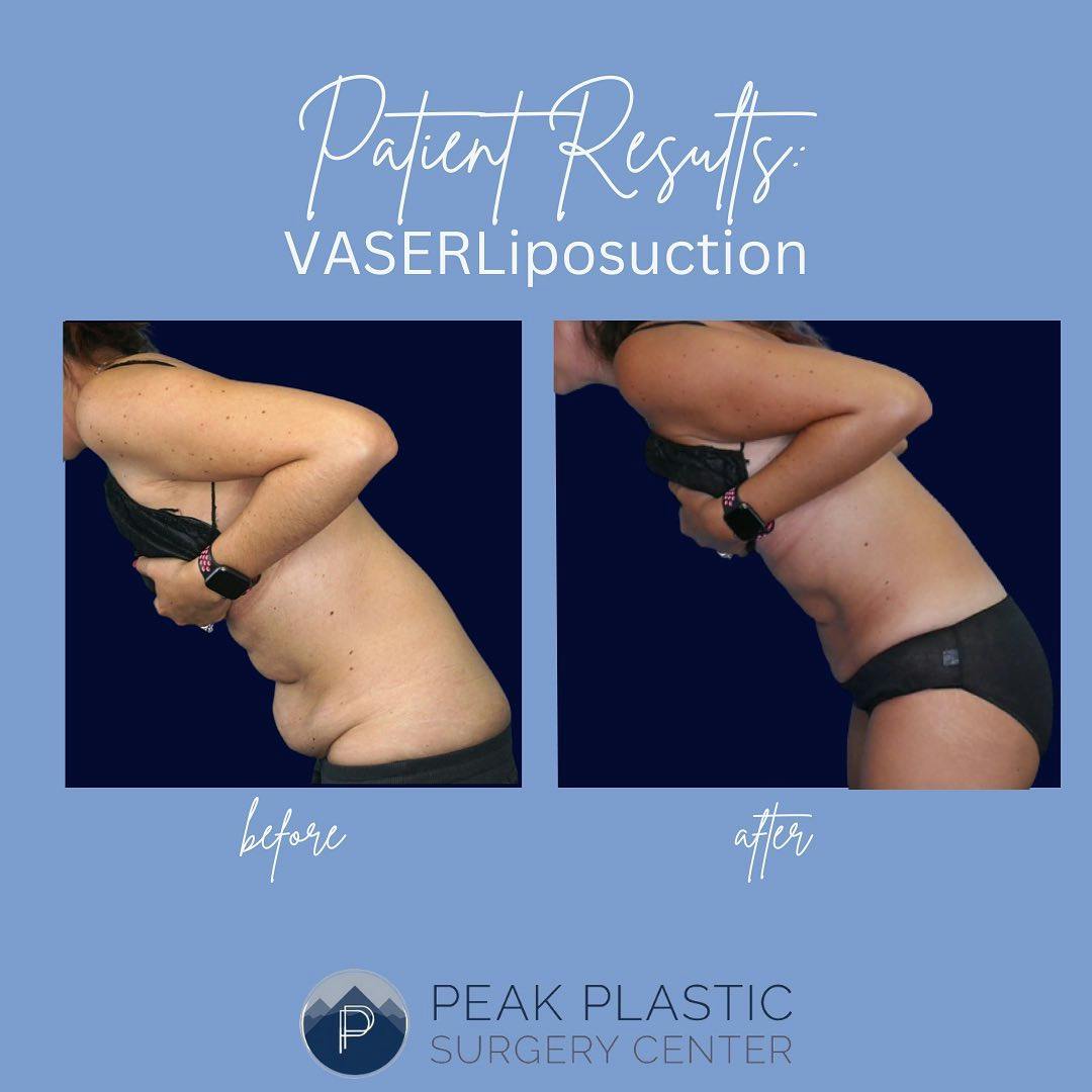 Vaser Liposuction Before & After Gallery - Patient 60748768 - Image 2