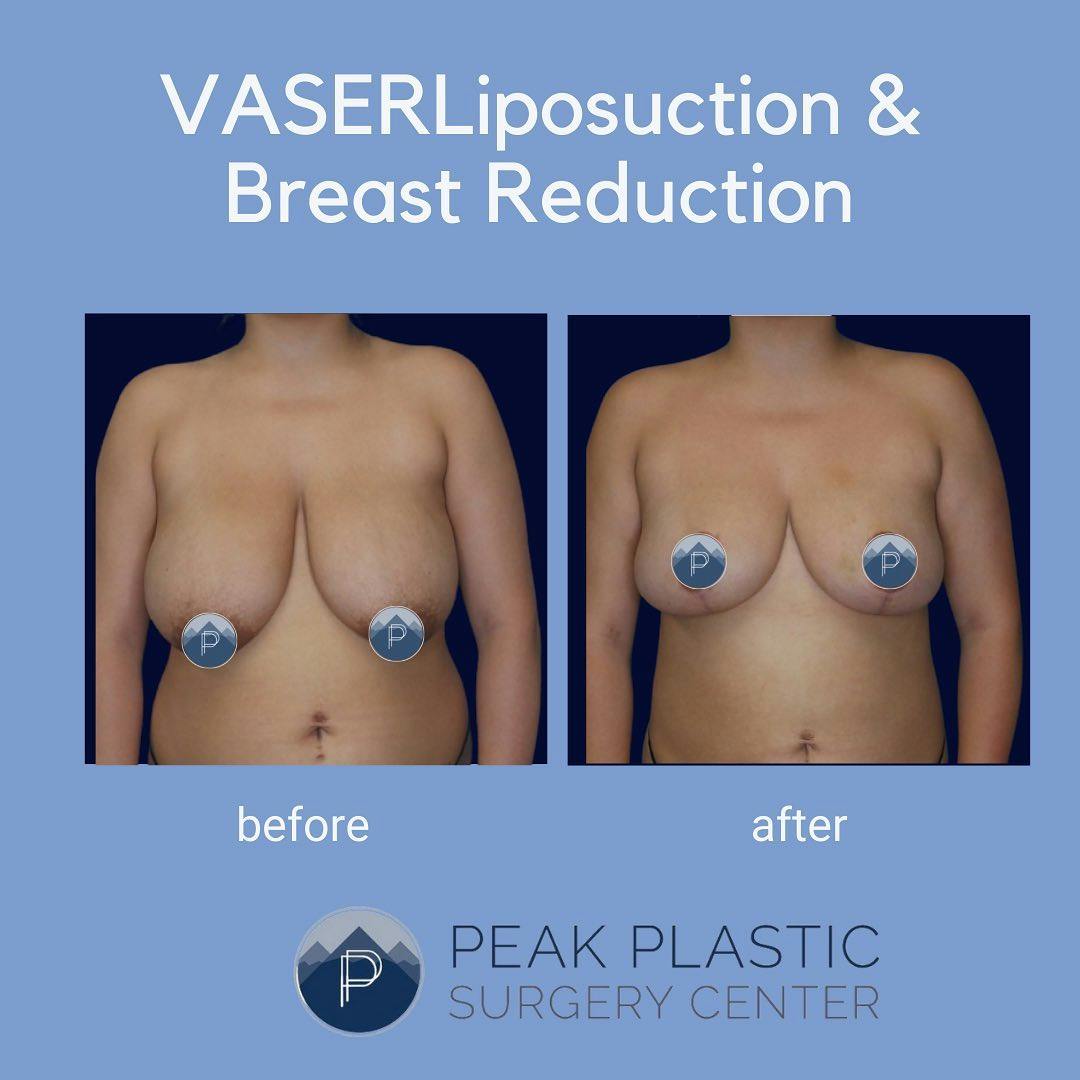 Breast Reduction Before & After Gallery - Patient 60750431 - Image 1