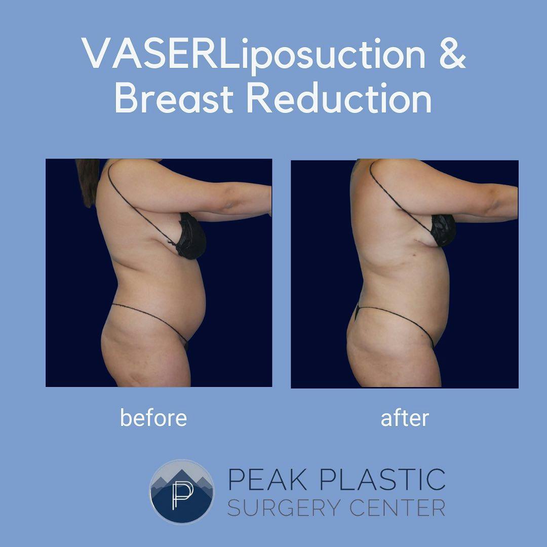 Vaser Liposuction Before & After Gallery - Patient 60750451 - Image 2