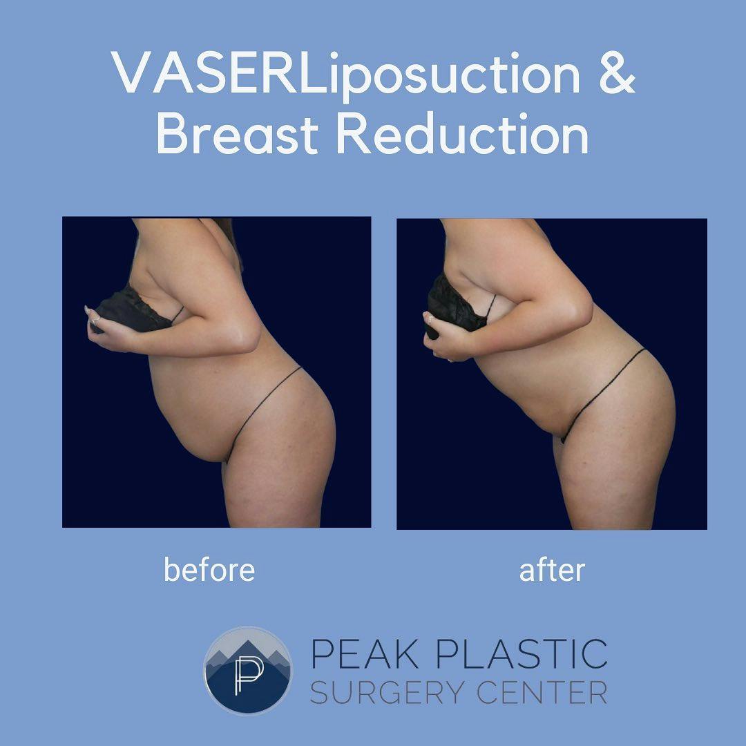 Vaser Liposuction Before & After Gallery - Patient 60750451 - Image 1