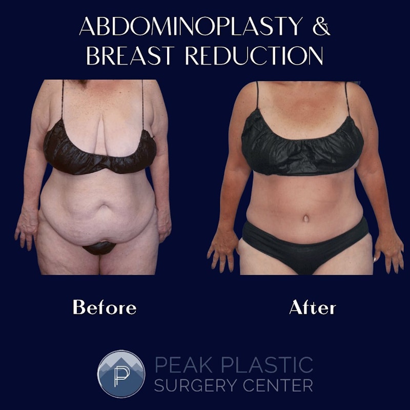 Breast Reduction Before & After Gallery - Patient 60750456 - Image 1