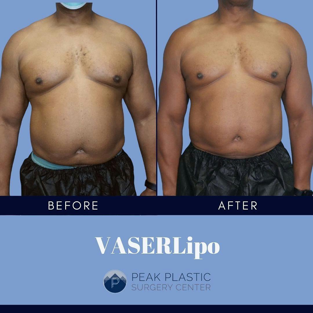 Vaser Liposuction Before & After Gallery - Patient 60750463 - Image 1