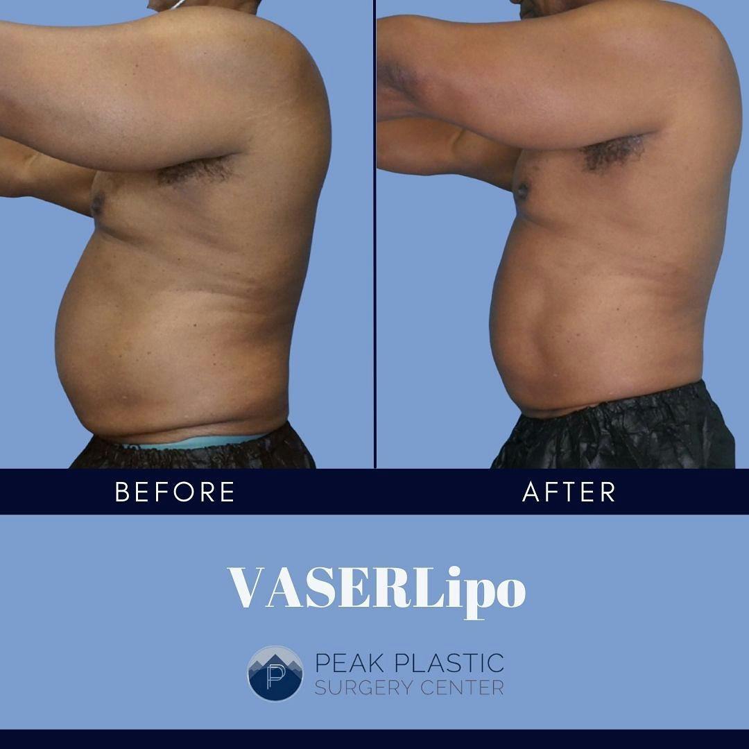 Vaser Liposuction Before & After Gallery - Patient 60750463 - Image 2