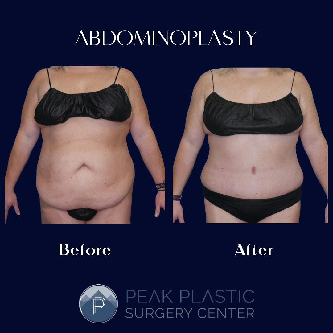 Tummy Tuck (Abdominoplasty)  Before & After Gallery - Patient 60750474 - Image 1