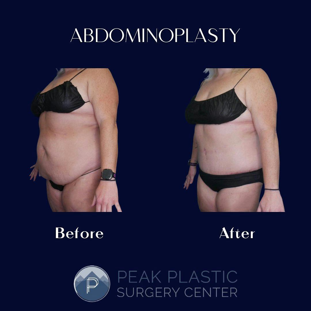 Tummy Tuck (Abdominoplasty)  Before & After Gallery - Patient 60750474 - Image 3