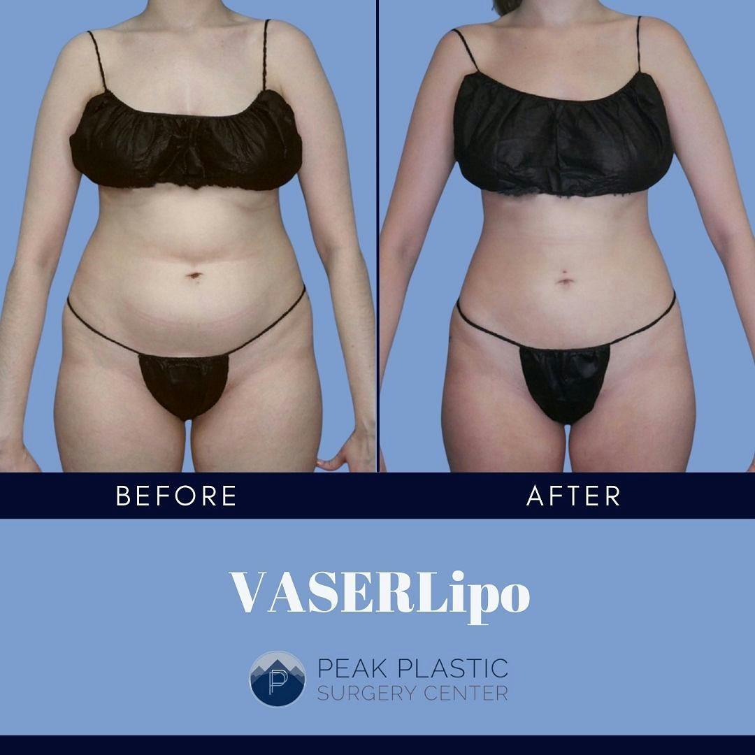 Vaser Liposuction Before & After Gallery - Patient 60754277 - Image 1