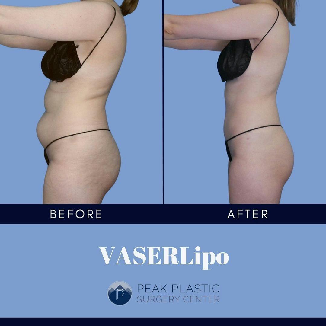 Vaser Liposuction Before & After Gallery - Patient 60754277 - Image 2