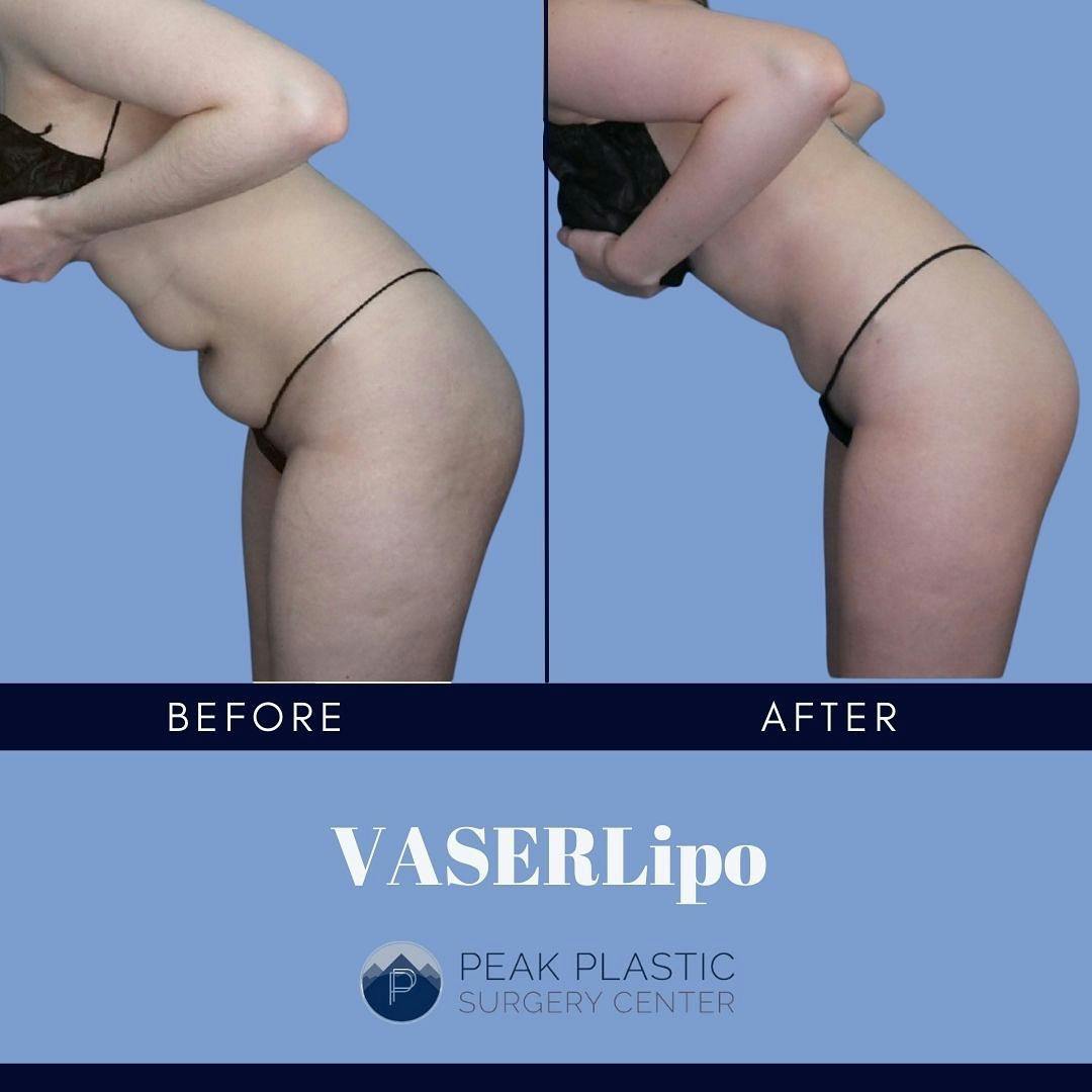 Vaser Liposuction Before & After Gallery - Patient 60754277 - Image 3