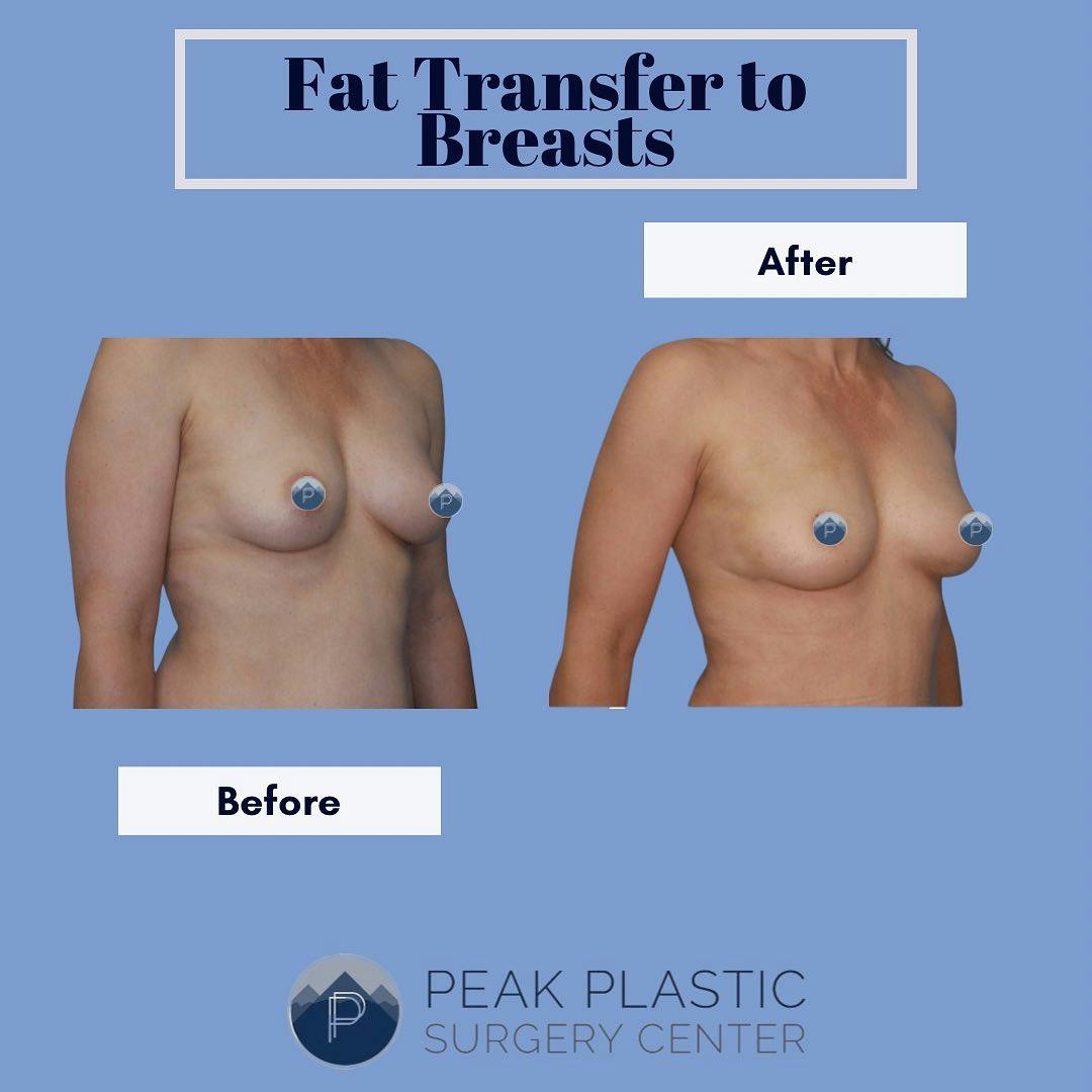 Breast Augmentation Before & After Gallery - Patient 60754280 - Image 2