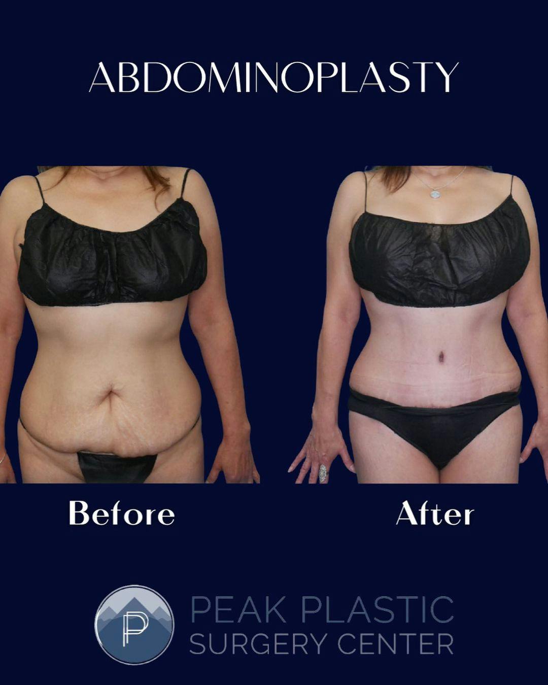 Breast Augmentation Before & After Gallery - Patient 60754283 - Image 3
