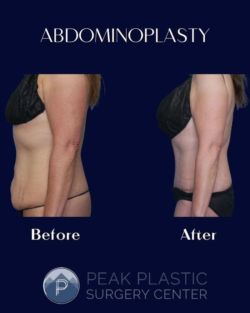 Tummy Tuck (Abdominoplasty)  Before & After Gallery - Patient 60754284 - Image 2