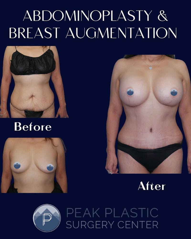 Tummy Tuck (Abdominoplasty)  Before & After Gallery - Patient 60754284 - Image 3