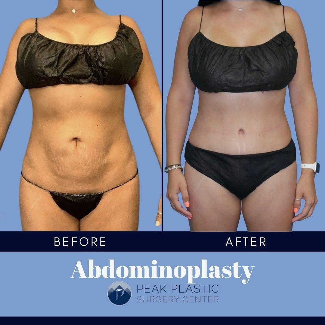 Tummy Tuck (Abdominoplasty)  Before & After Gallery - Patient 60754302 - Image 1