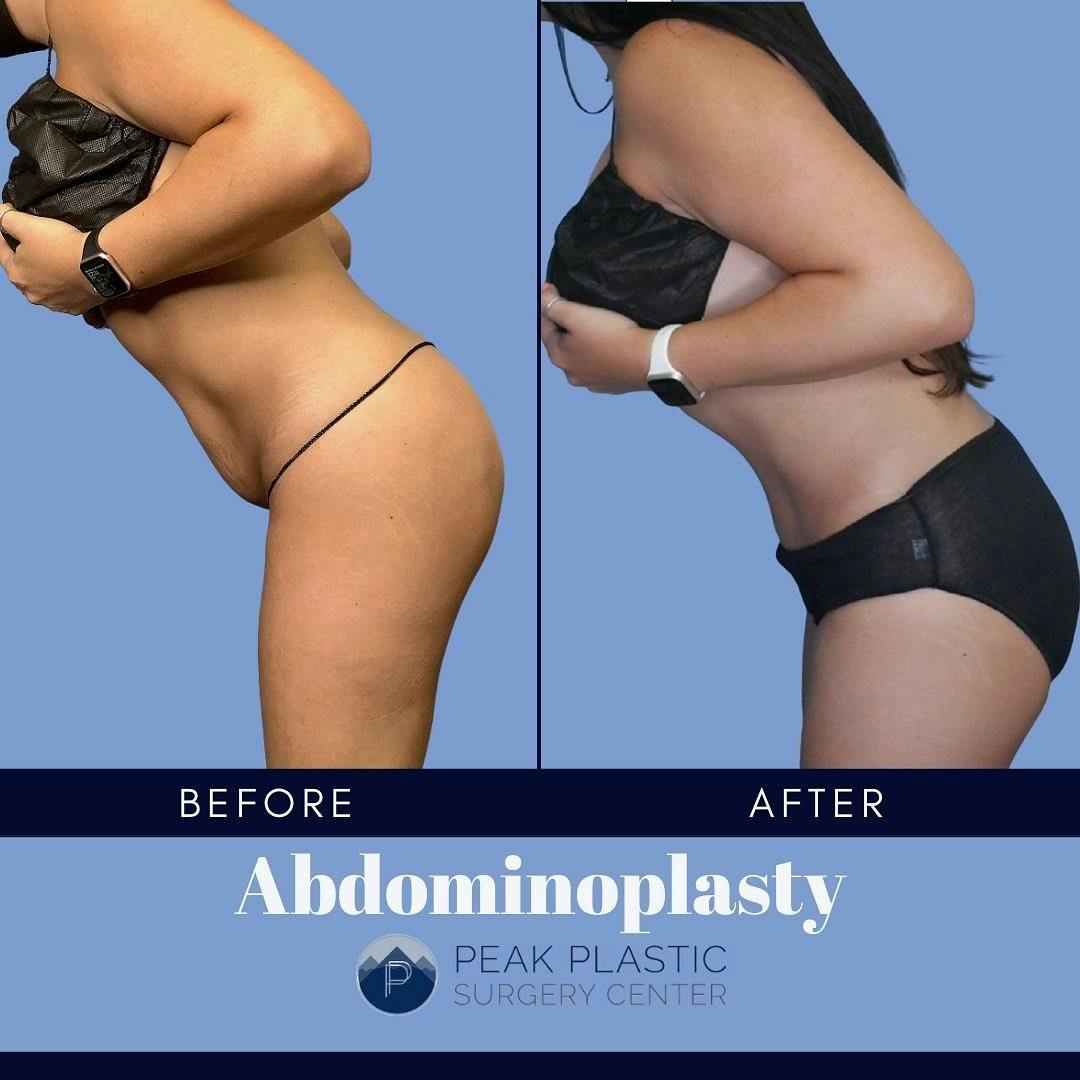 Tummy Tuck (Abdominoplasty)  Before & After Gallery - Patient 60754302 - Image 2