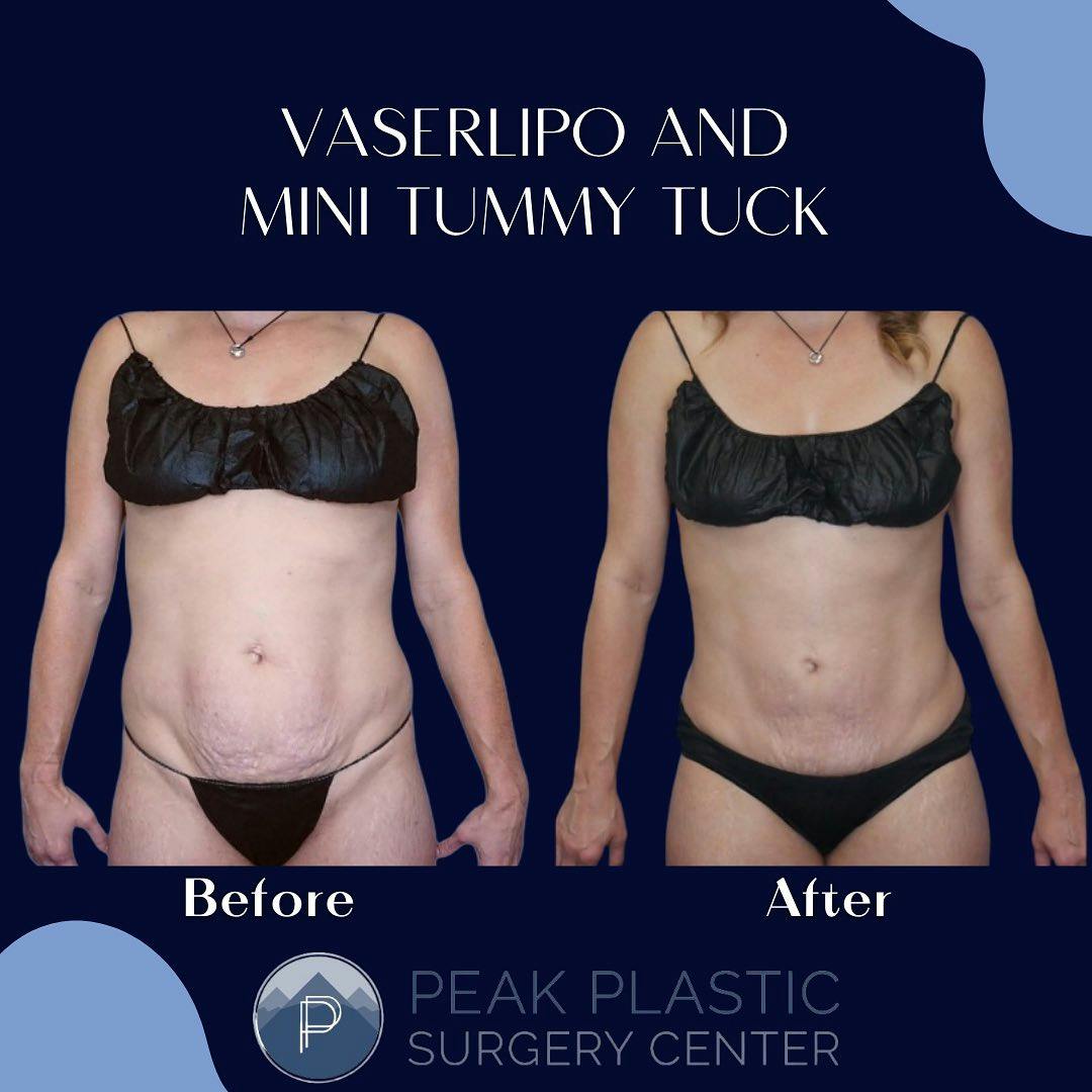 Tummy Tuck (Abdominoplasty)  Before & After Gallery - Patient 60754317 - Image 1