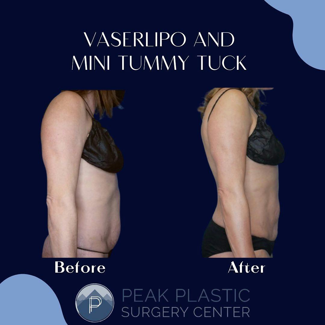 Vaser Liposuction Before & After Gallery - Patient 60754319 - Image 2