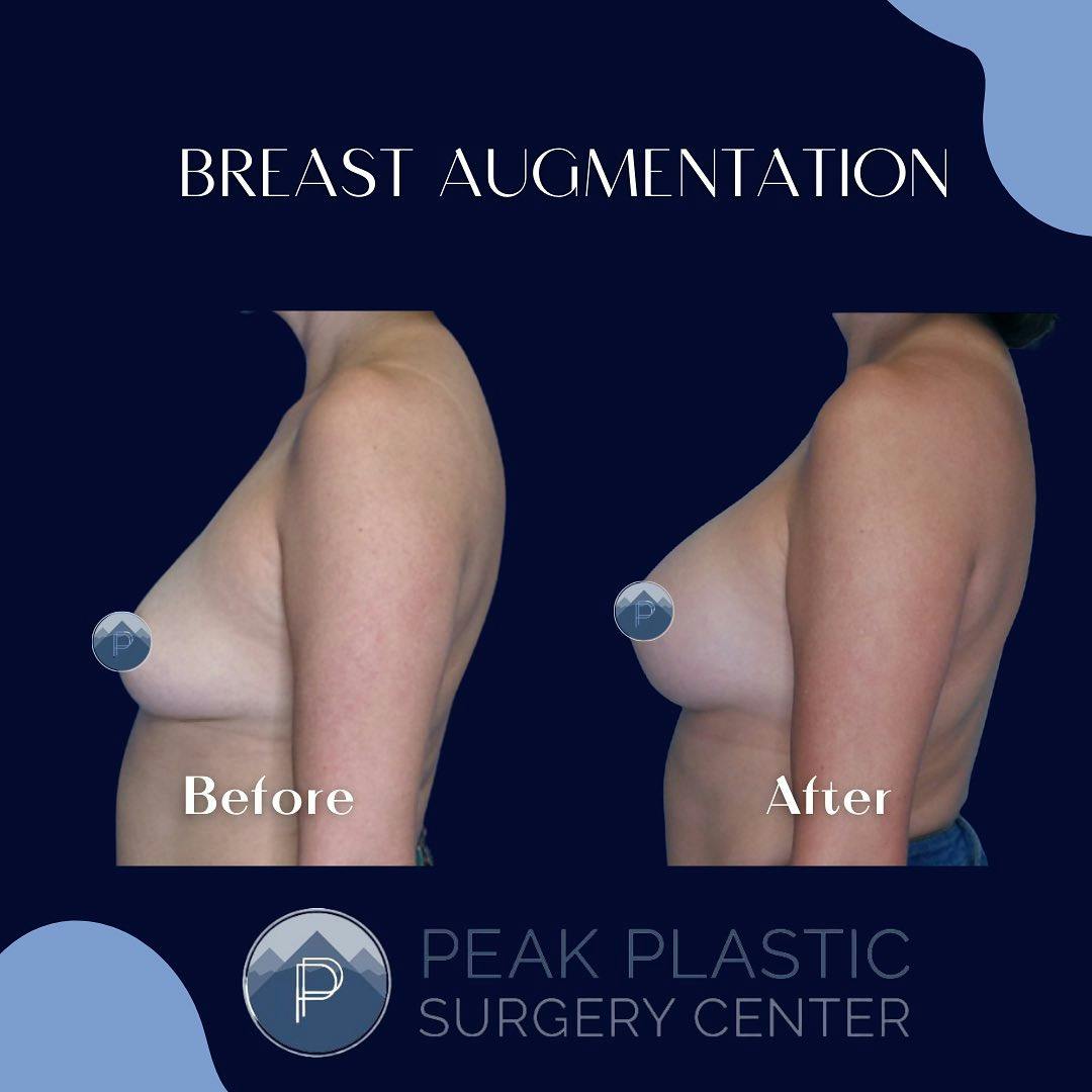 Breast Augmentation Before & After Gallery - Patient 60754322 - Image 2