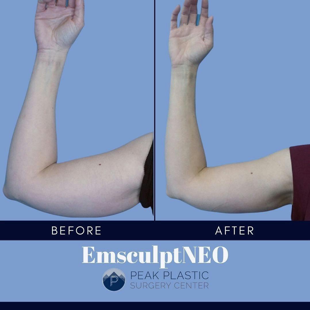 Emsculpt Neo® Before & After Gallery - Patient 60754324 - Image 1