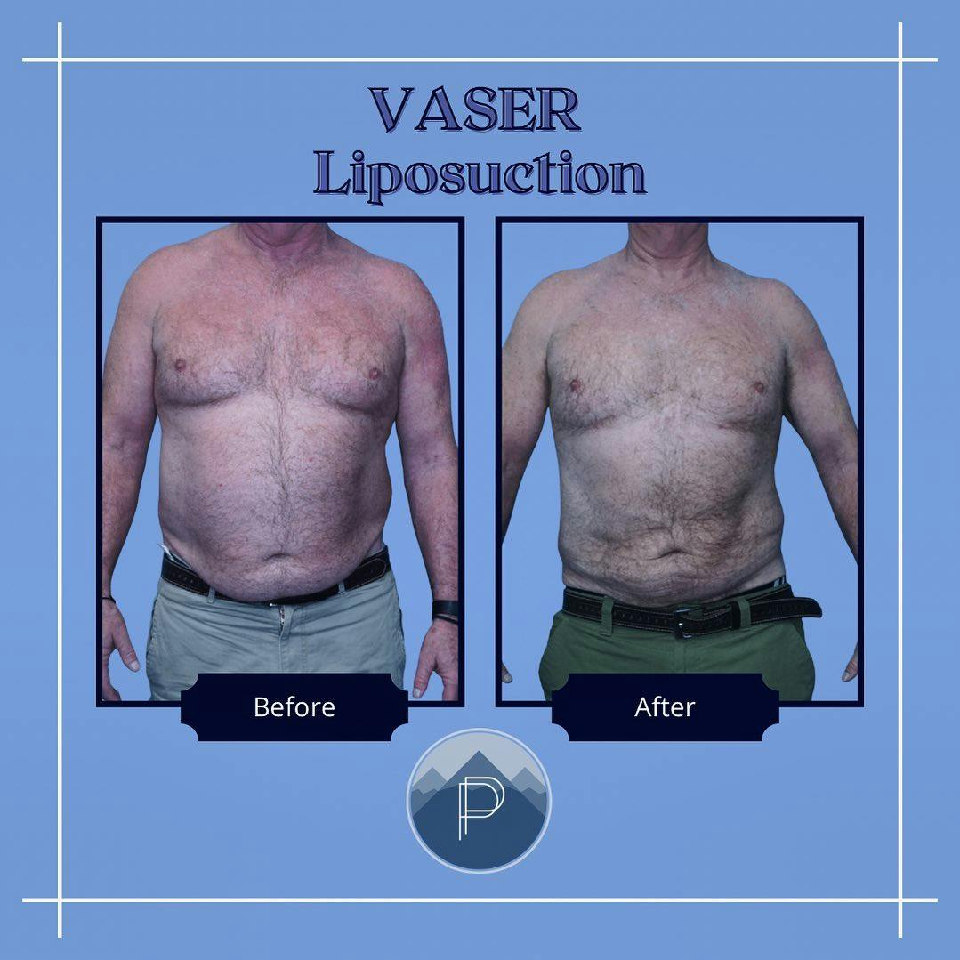 Vaser Liposuction Before & After Gallery - Patient 60754350 - Image 1