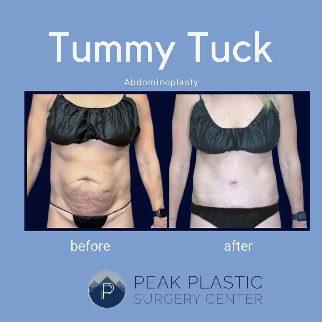 Tummy Tuck (Abdominoplasty)  Before & After Gallery - Patient 60754357 - Image 1