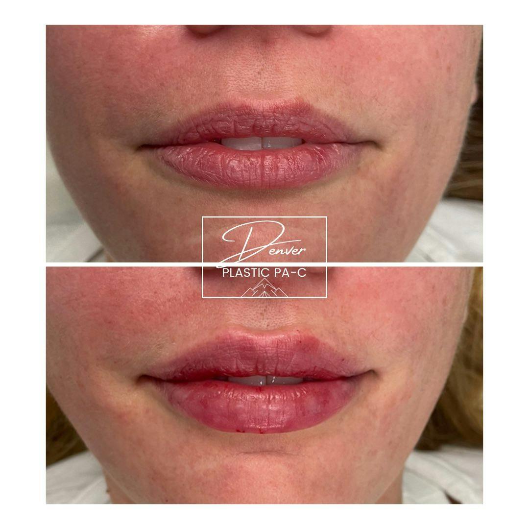 Lip Fillers Before & After Gallery - Patient 60754365 - Image 1