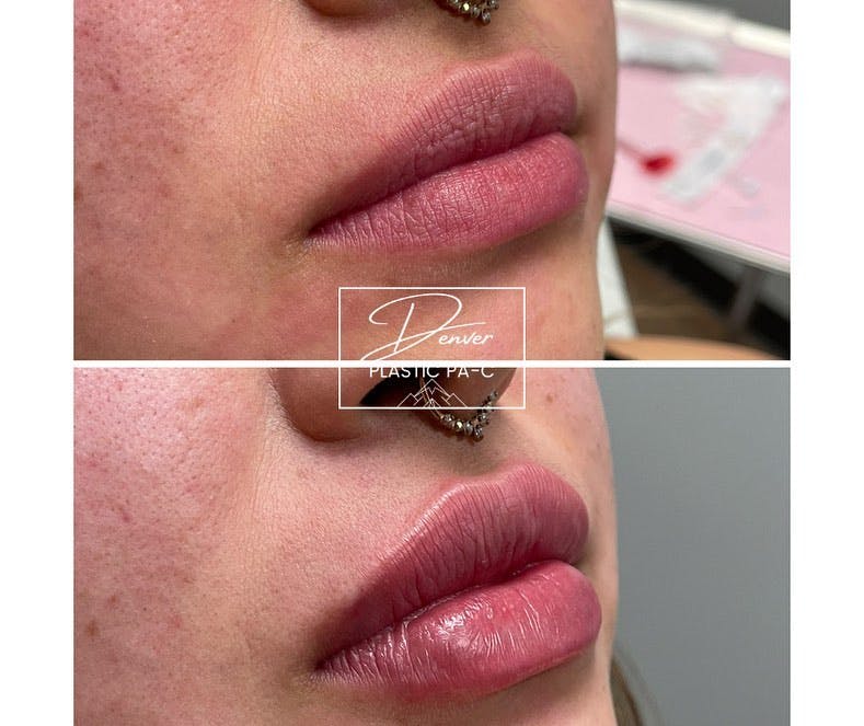 Lip Fillers Before & After Gallery - Patient 60754369 - Image 1