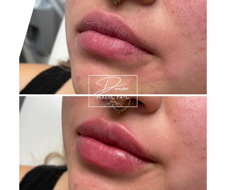 Lip Fillers Before & After Gallery - Patient 60754369 - Image 2