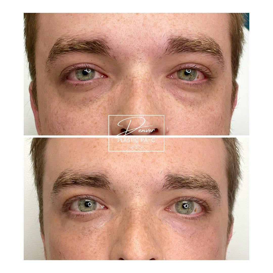 RHA® Fillers Before & After Gallery - Patient 60754398 - Image 1