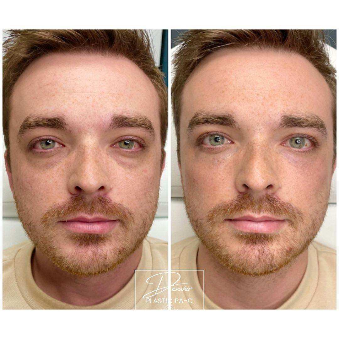 RHA® Fillers Before & After Gallery - Patient 60754398 - Image 2