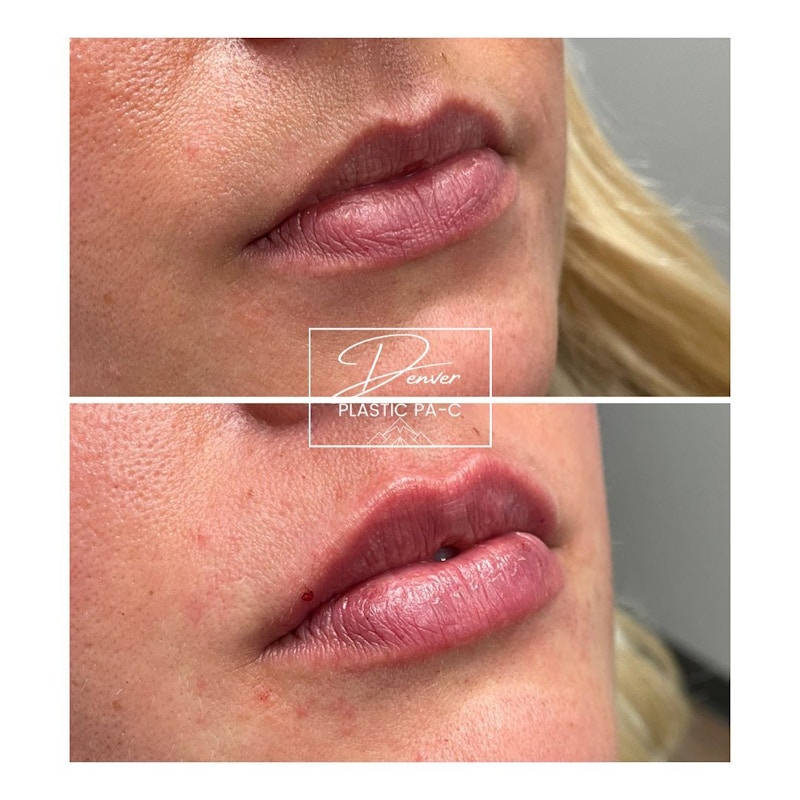 Lip Fillers Before & After Gallery - Patient 60754403 - Image 1