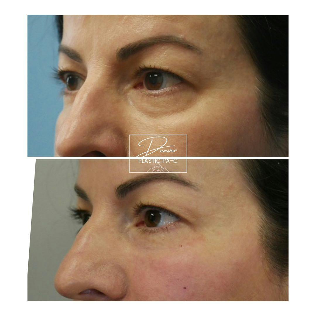 Facial Rejuvenation Before & After Gallery - Patient 60754428 - Image 2