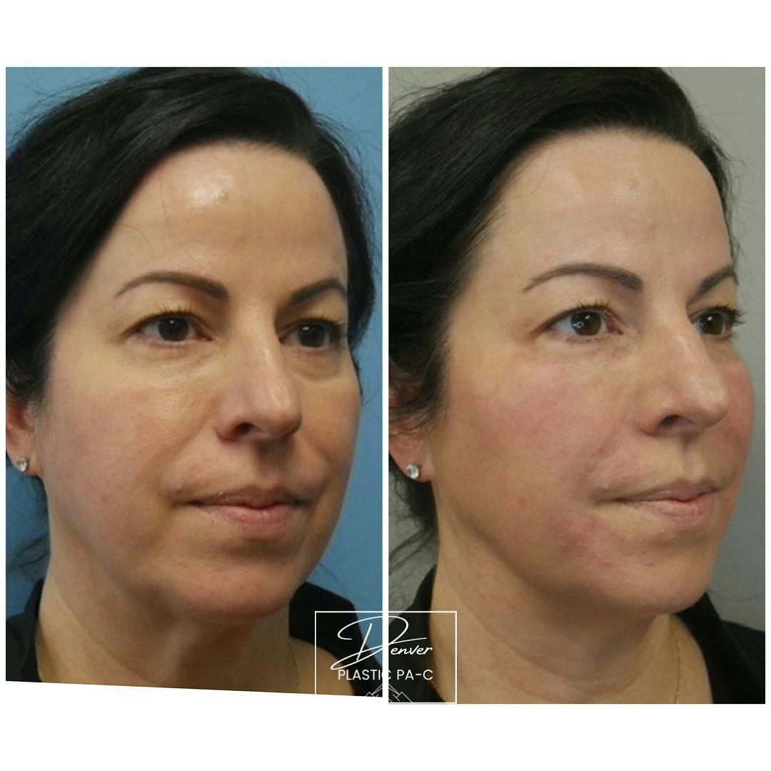 Facial Rejuvenation Before & After Gallery - Patient 60754428 - Image 3