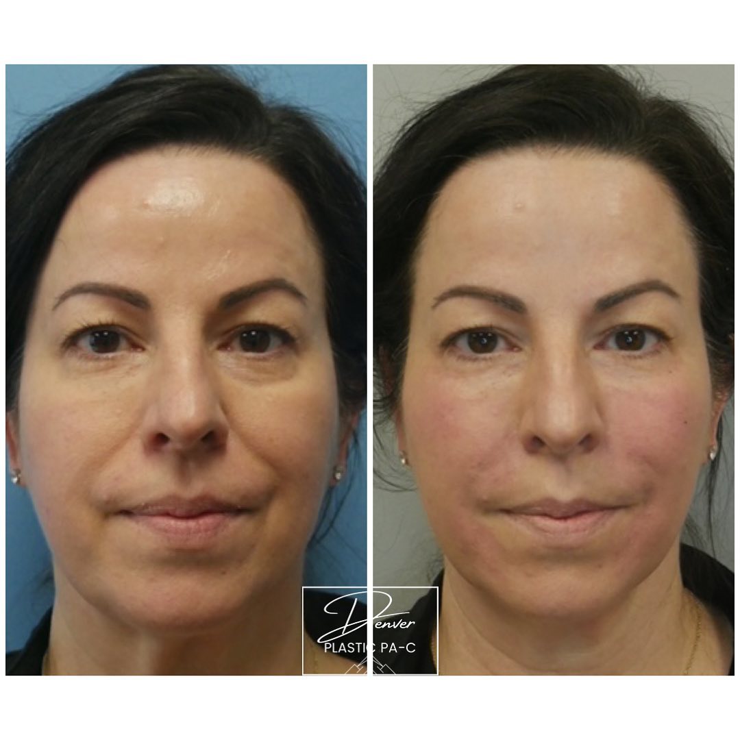 Patient 60754428 Facial Rejuvenation Before & After Photos Peak