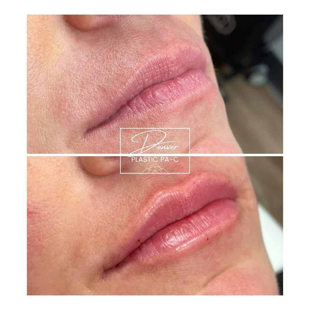Lip Fillers Before & After Gallery - Patient 60754433 - Image 1