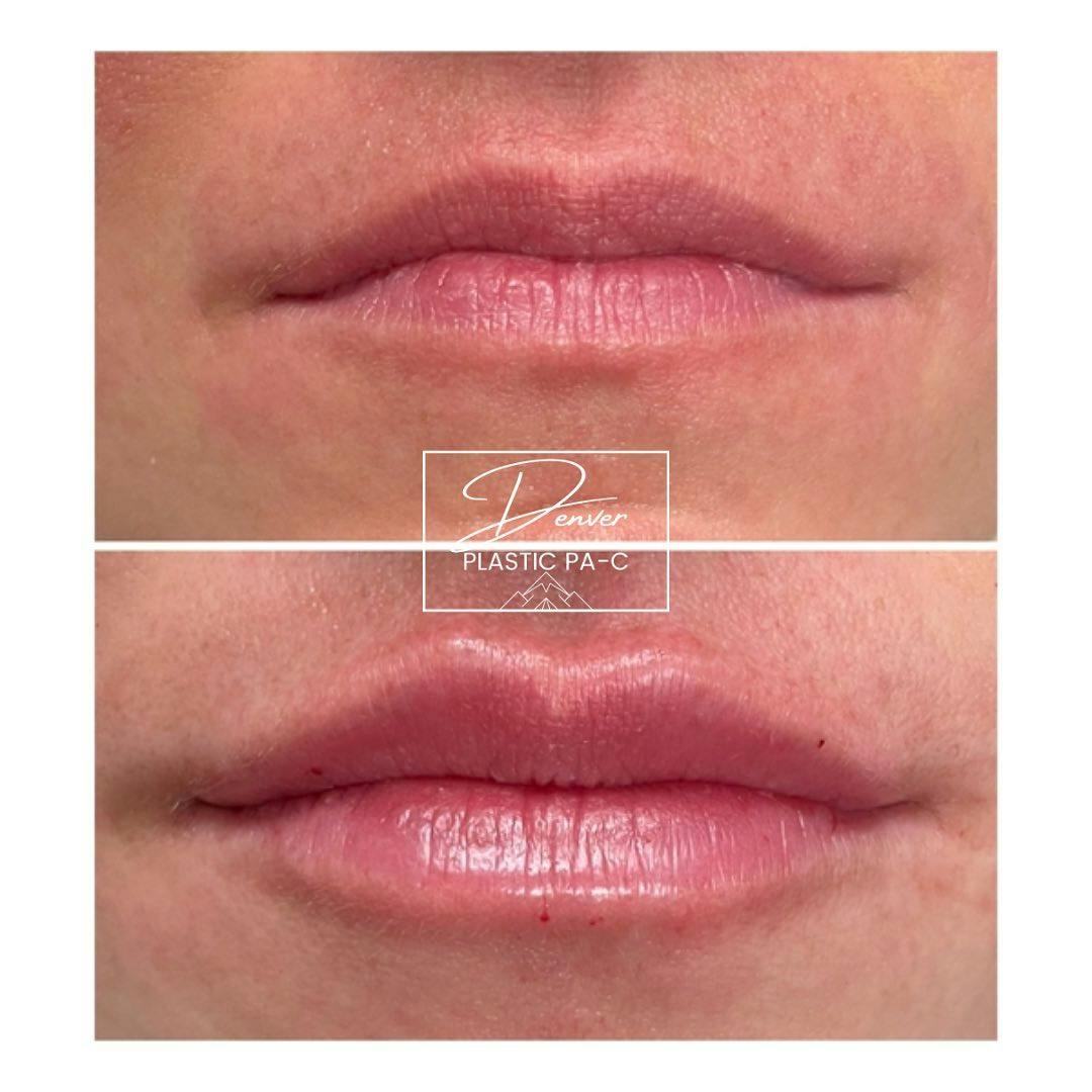 Lip Fillers Before & After Gallery - Patient 60754433 - Image 2