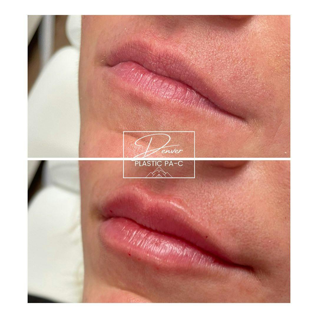 Lip Fillers Before & After Gallery - Patient 60754433 - Image 3