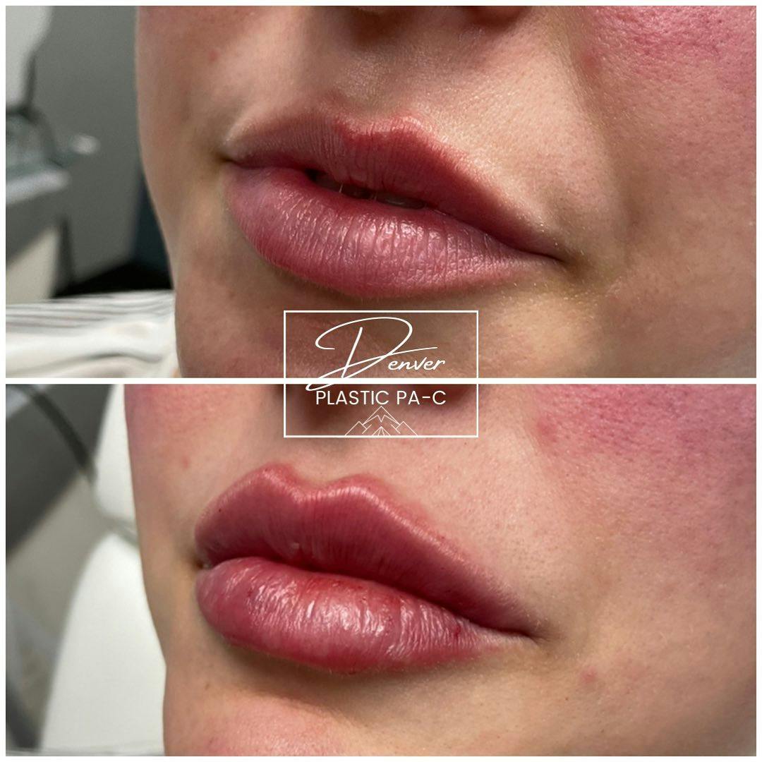 Lip Fillers Before & After Gallery - Patient 60754581 - Image 3