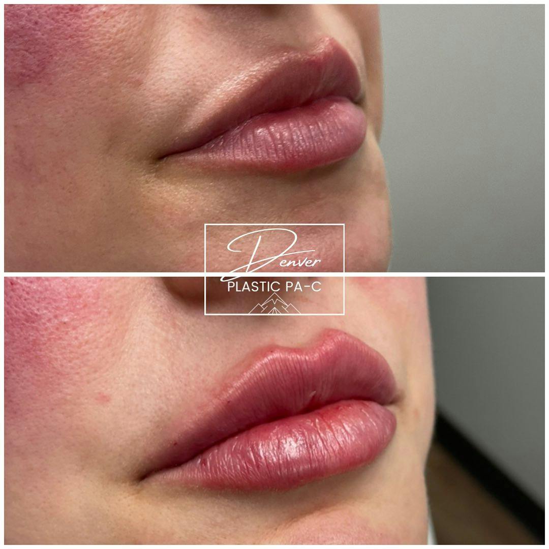 Lip Fillers Before & After Gallery - Patient 60754581 - Image 1