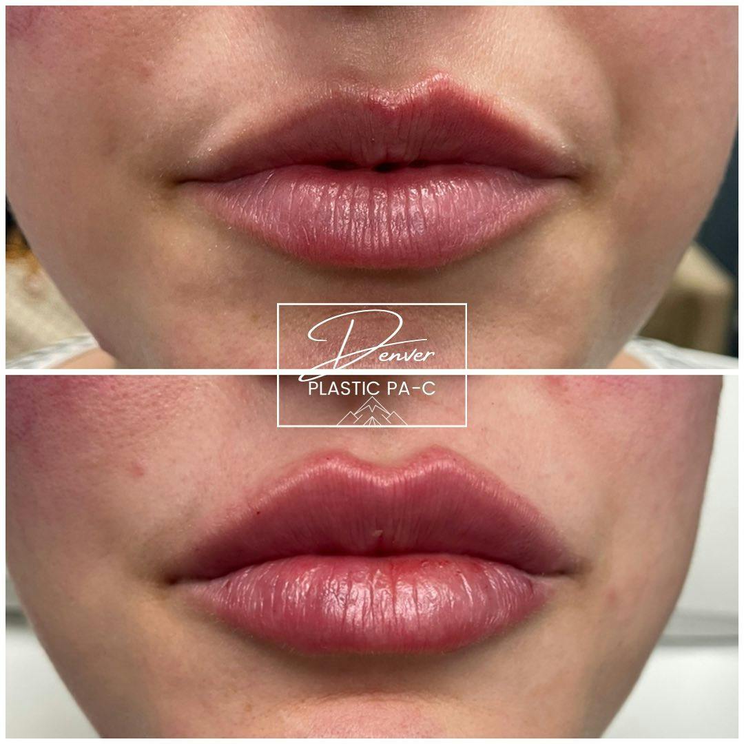 Lip Fillers Before & After Gallery - Patient 60754581 - Image 2