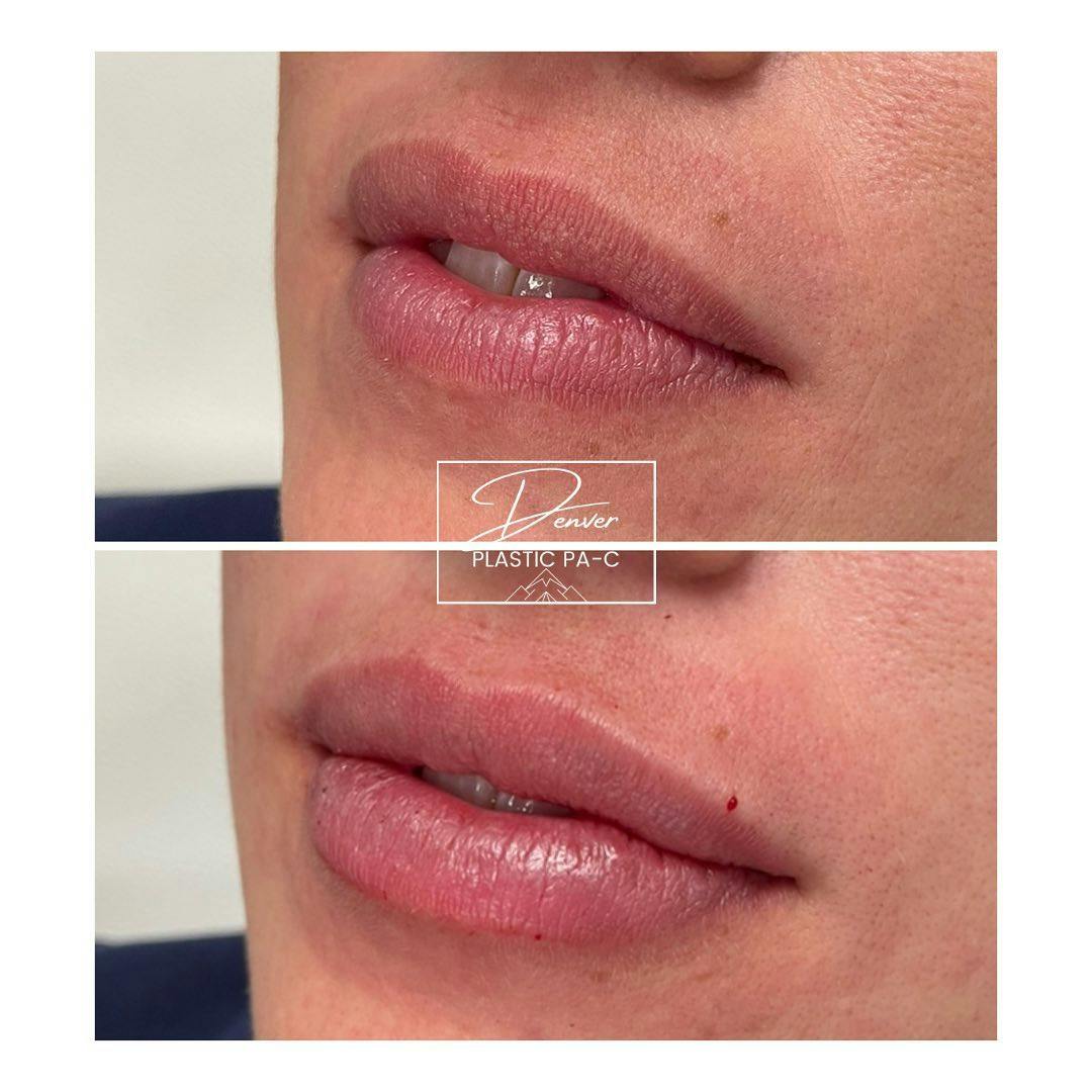 Lip Fillers Before & After Gallery - Patient 60754593 - Image 2