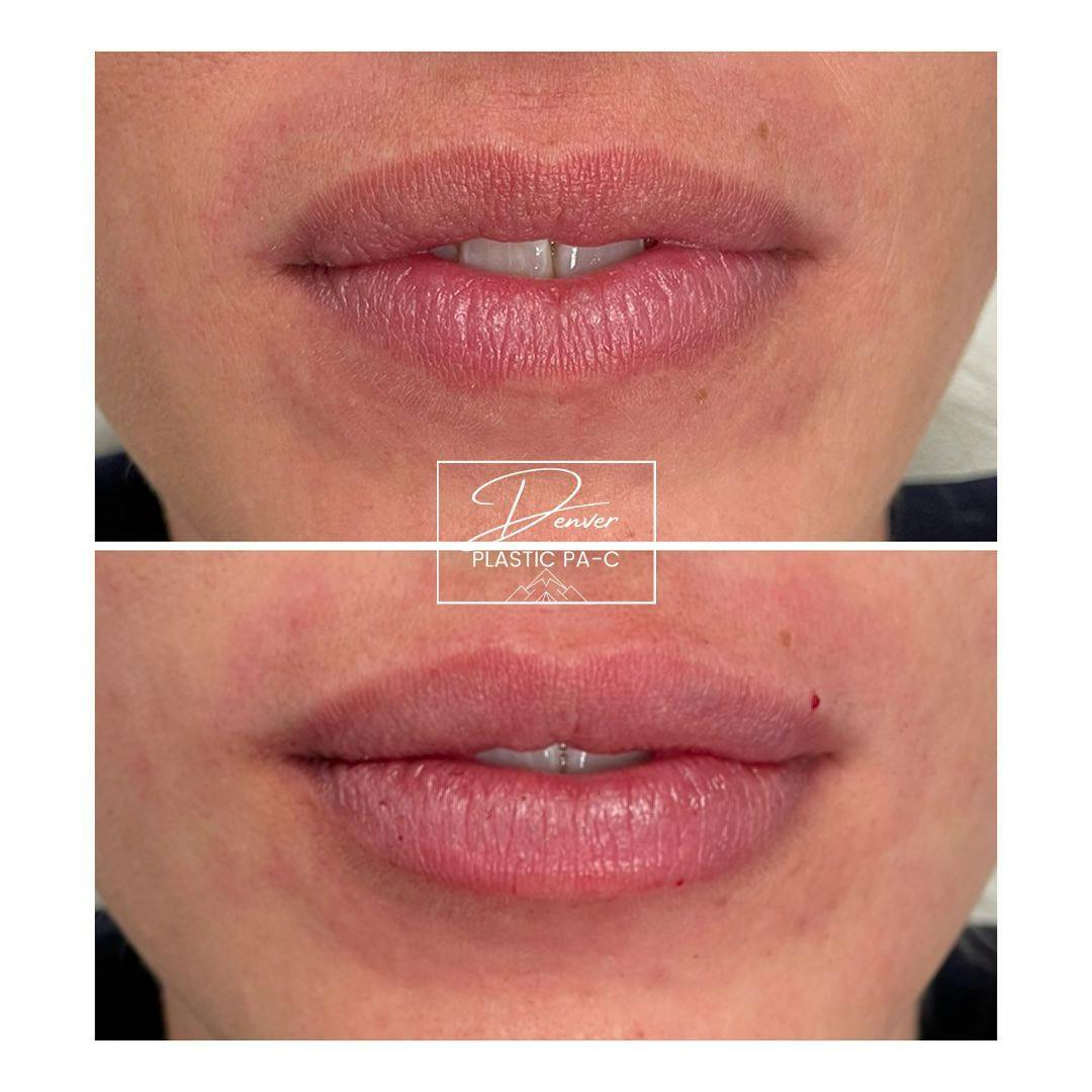 Lip Fillers Before & After Gallery - Patient 60754593 - Image 3
