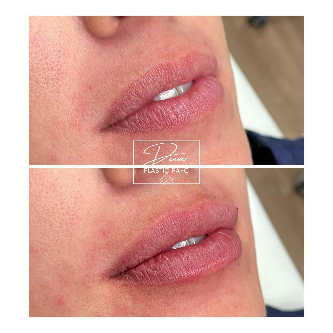 Lip Fillers Before & After Gallery - Patient 60754593 - Image 1