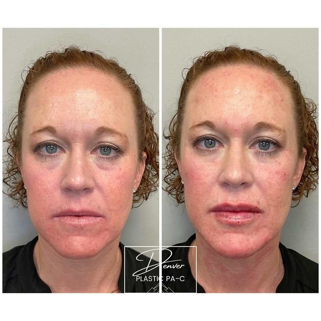 Facial Rejuvenation Before & After Gallery - Patient 60754596 - Image 1
