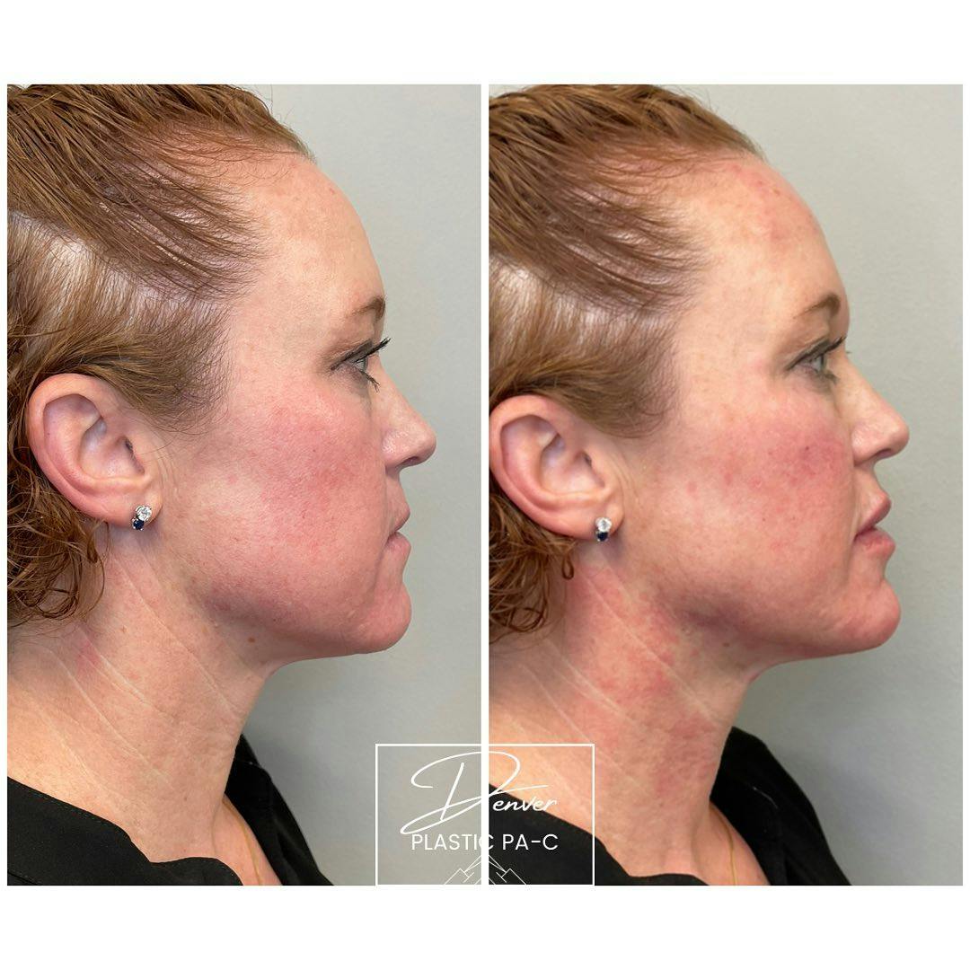 Facial Rejuvenation Before & After Gallery - Patient 60754596 - Image 2