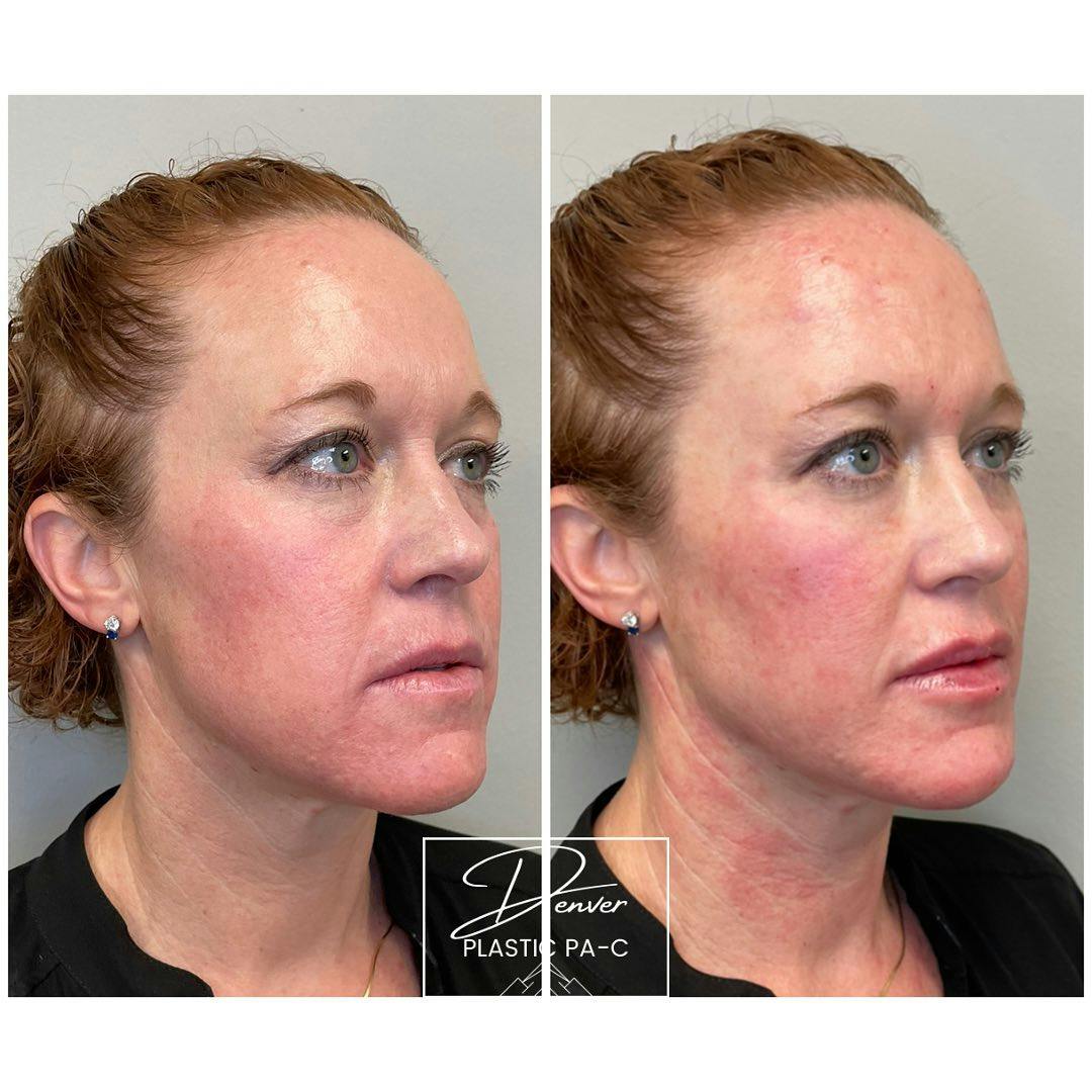 Facial Rejuvenation Before & After Gallery - Patient 60754596 - Image 3